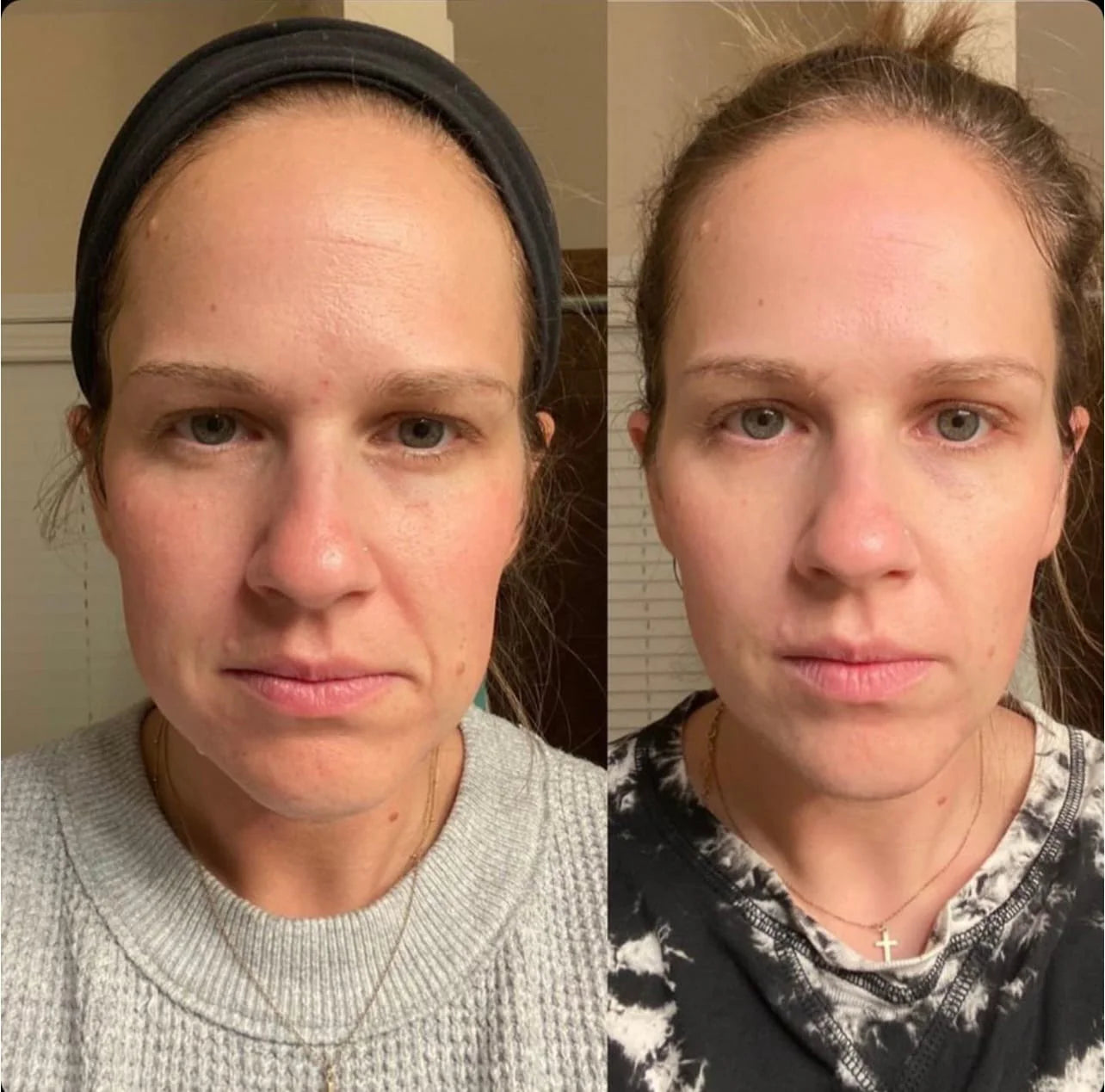 Liftaé™ Anti-Wrinkle Tapes
