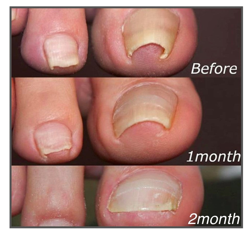 ToeFix+ Nail patches | Get rid of nail fungus for good!