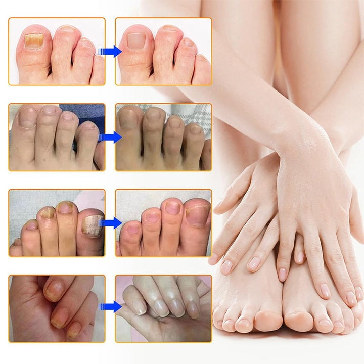 NailNex™ Effective Treatment for Nail Fungus
