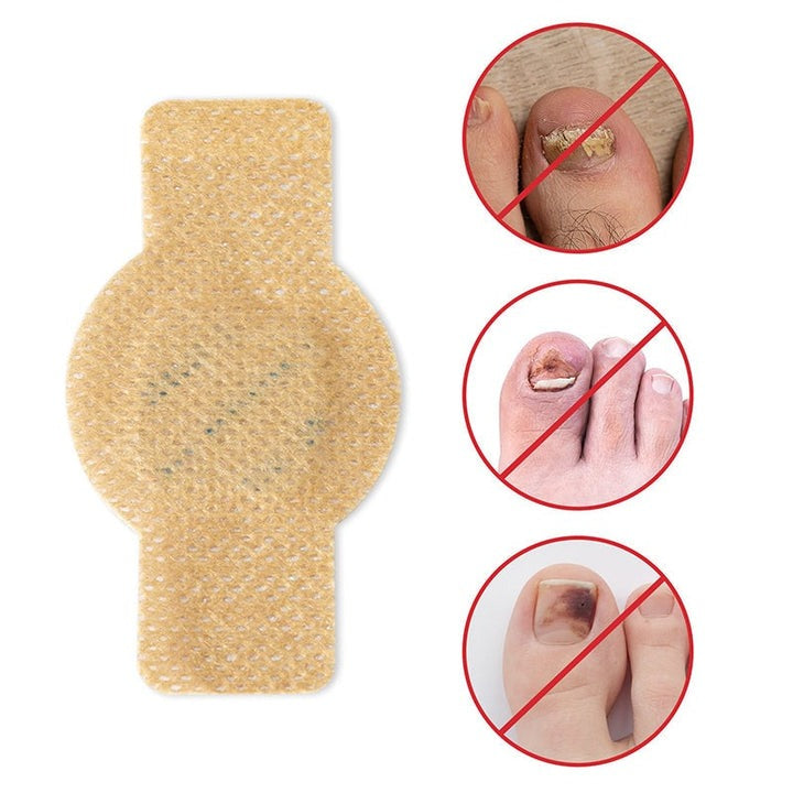 NailNex™ Effective Treatment for Nail Fungus