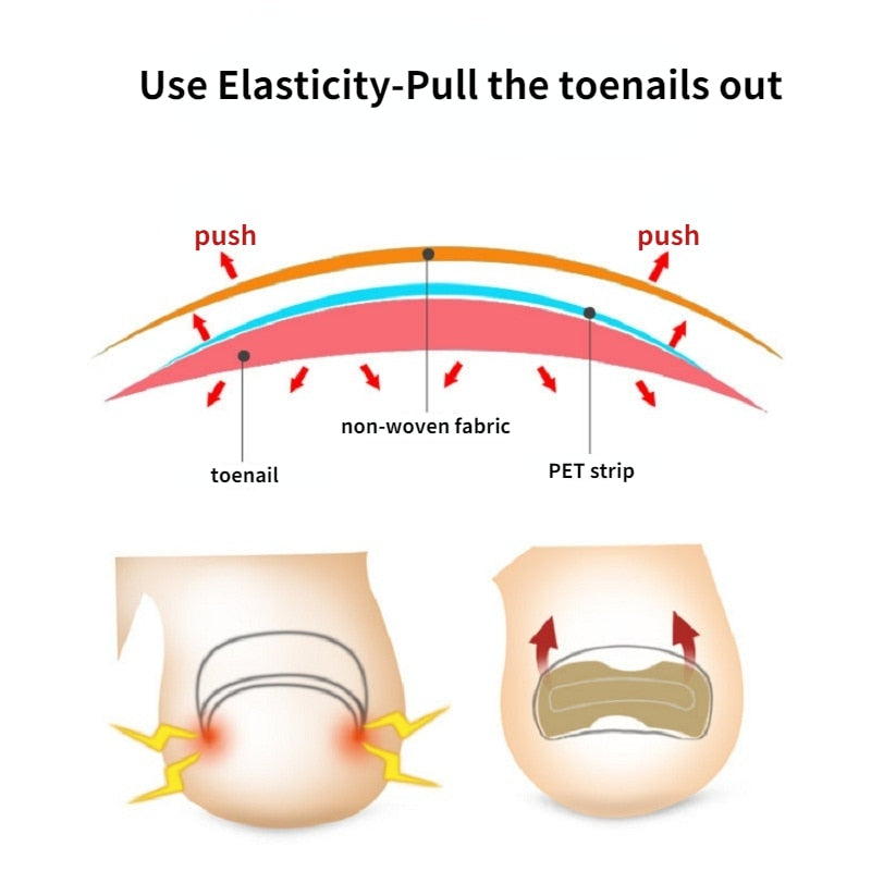 ToeFix+ Nail patches | Get rid of nail fungus for good!