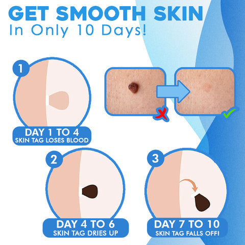 TagAway™ Advanced Callus Removal Kit