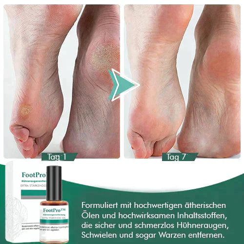 FootPro™️ Corn removal gel