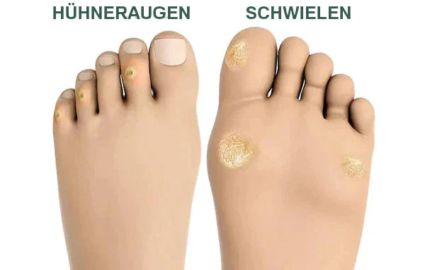 FootPro™️ Corn removal gel