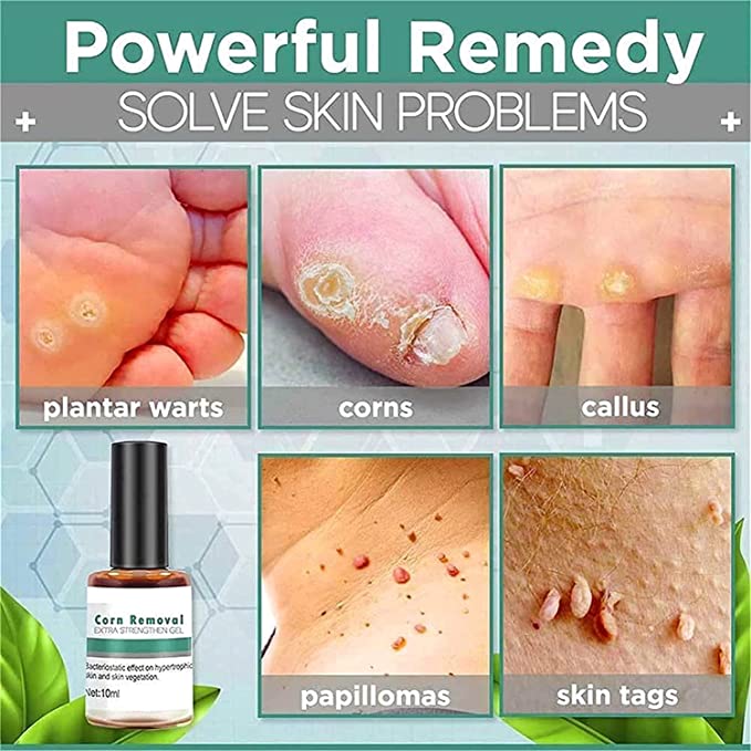 FootPro™️ Corn removal gel