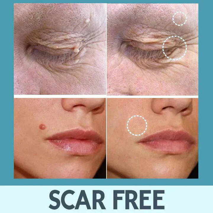 CoverLux™ Patches for removing skin spots and moles