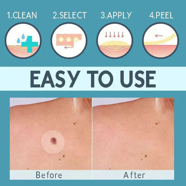 CoverLux™ Patches for removing skin spots and moles