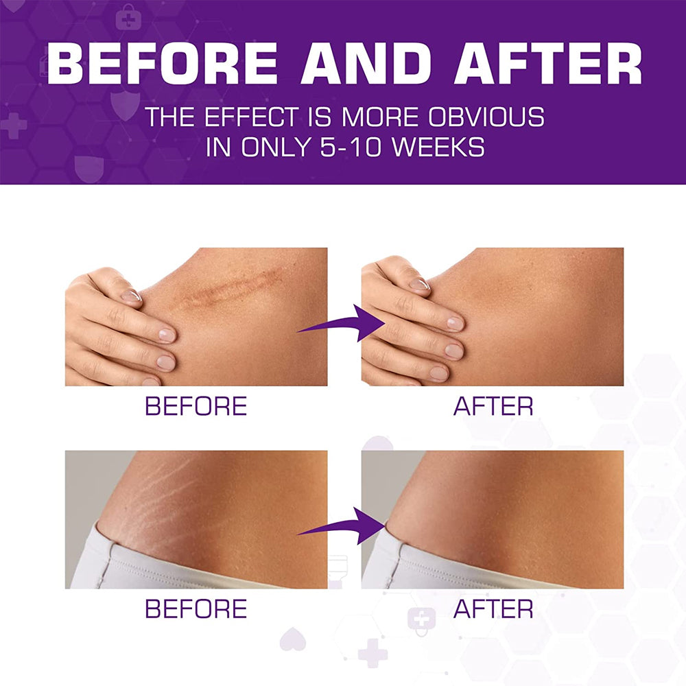Dermarene™ Reusable Silicone Scar Plasters