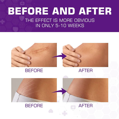 Dermarene™ Reusable Silicone Scar Plasters