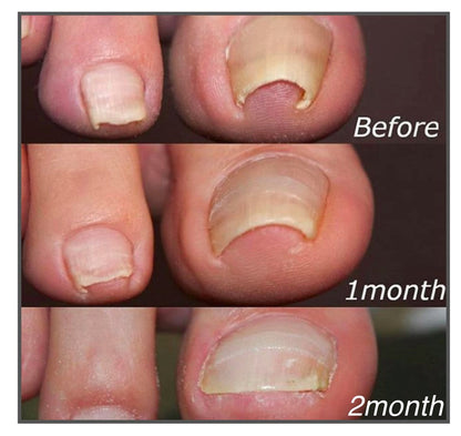 ToeFix+ Nail patches | Get rid of nail fungus for good!
