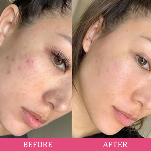 NueDerma™ High frequency skincare wand