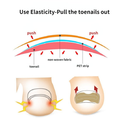ToeFix+ Nail patches | Get rid of nail fungus for good!