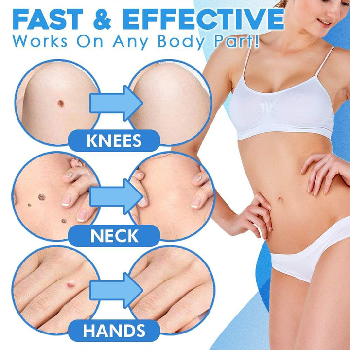 TagAway™ Advanced Callus Removal Kit