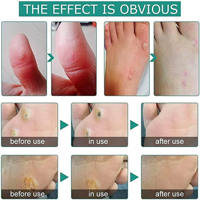 FootPro™️ Corn removal gel
