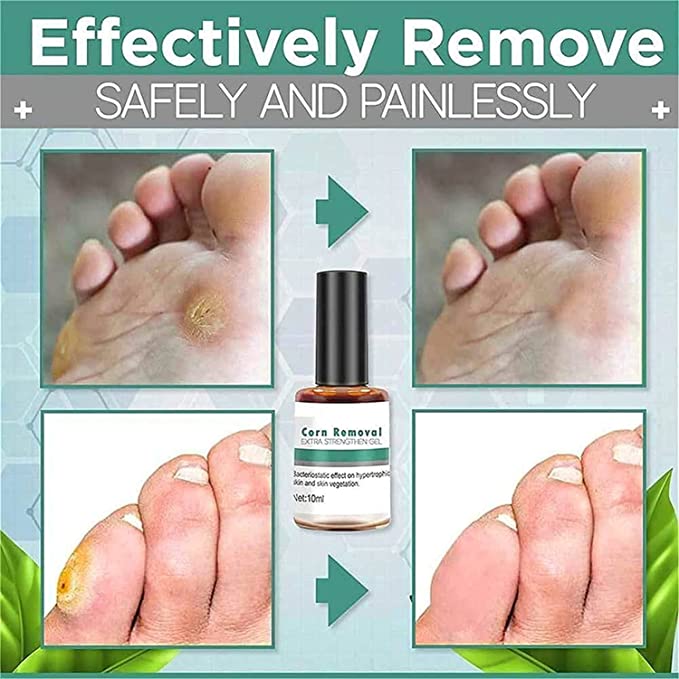 FootPro™️ Corn removal gel