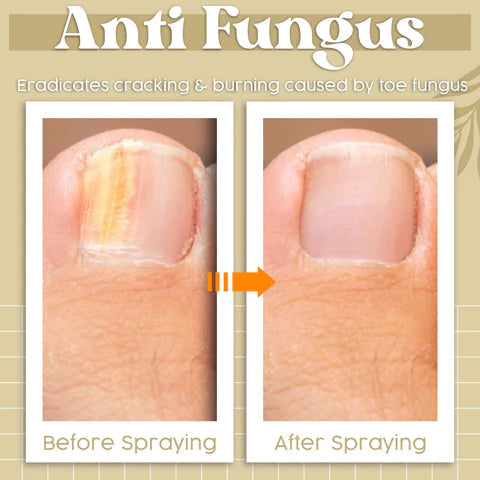 Herbcure™ Antifungal Spray