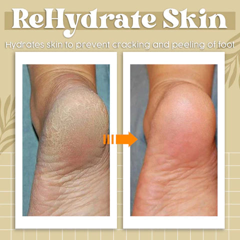Herbcure™ Antifungal Spray