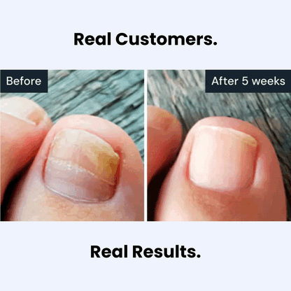 NailClear Pro+™ Nail Renewal Pen for Clearer Nails