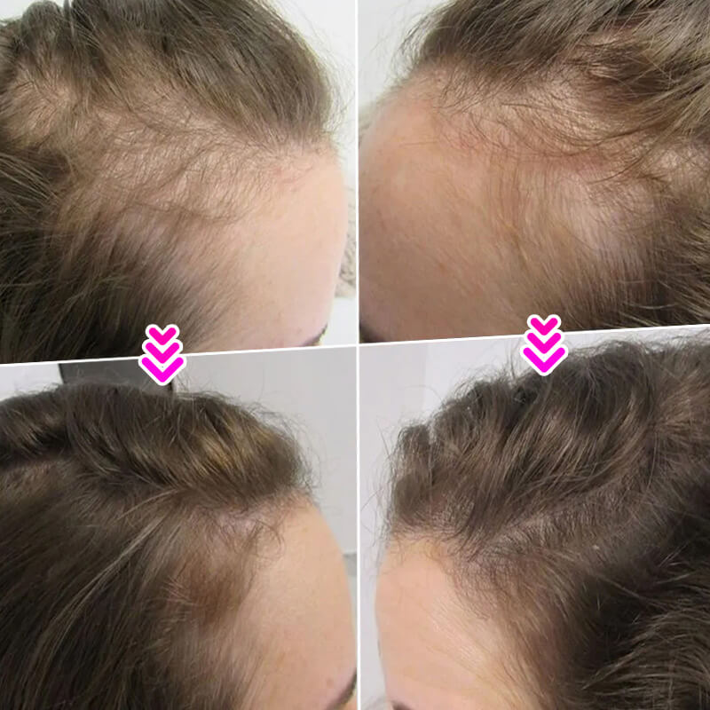 EELHOE HAIR™  Powder against hair loss and quick filling of the hairline
